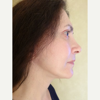 45-54 year old woman treated with Facelift after 3749268