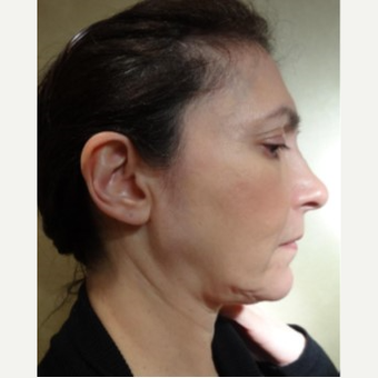 45-54 year old woman treated with Facelift before 3749268