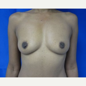 Breast Implant Revision before 3168556