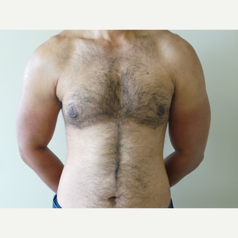 25-34 year old man treated with Male Breast Reduction after 3454562