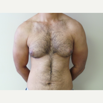 25-34 year old man treated with Male Breast Reduction before 3454562