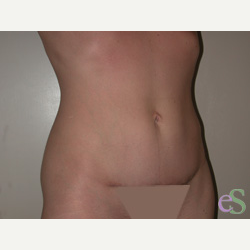 41 year old woman treated with Tummy Tuck after 3484823