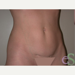 41 year old woman treated with Tummy Tuck before 3484823