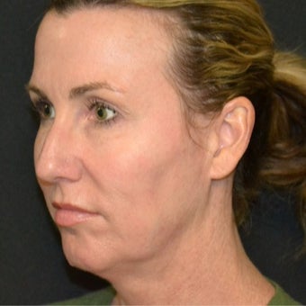 35-44 year old woman treated with Ultherapy before 1886158