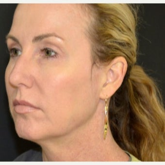 35-44 year old woman treated with Ultherapy after 1886158