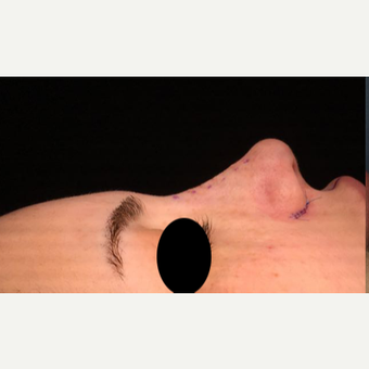 25-34 year old woman treated with Rhinoplasty after 3211265