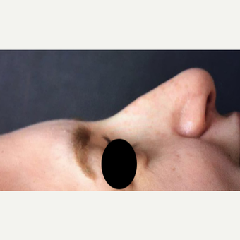 25-34 year old woman treated with Rhinoplasty before 3211265
