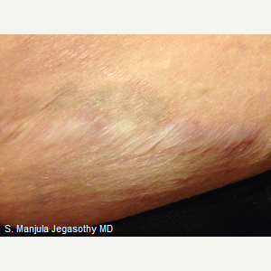 Complicated Tattoo Removal with Nd:Yag Laser after 2308252