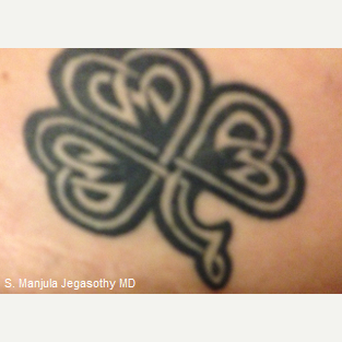 Complicated Tattoo Removal with Nd:Yag Laser before 2308252