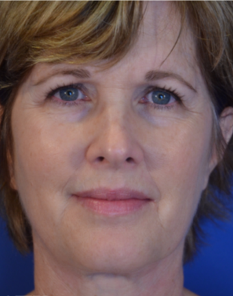 58 year old woman post Facelift, Upper Eyelid Blepharoplasty and Fat Transfer to the cheeks after 3742929