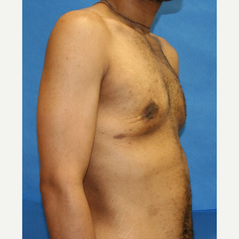 35-44 year old man treated with Male Breast Reduction after 3292208