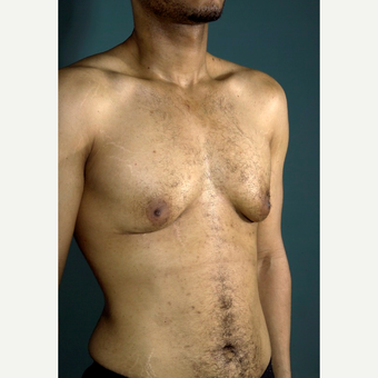 35-44 year old man treated with Male Breast Reduction before 3292208