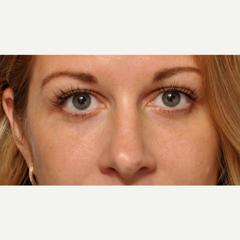 Under Eye Fillers with Bruiseless Technique after 3691670