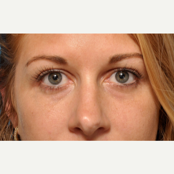 Under Eye Fillers with Bruiseless Technique before 3691670