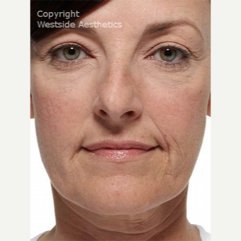 Radiesse Nasolabial Folds and Corners of Mouth before 2972648