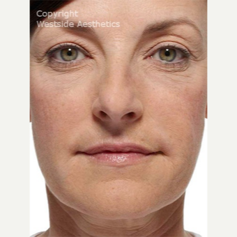 Radiesse Nasolabial Folds and Corners of Mouth after 2972648