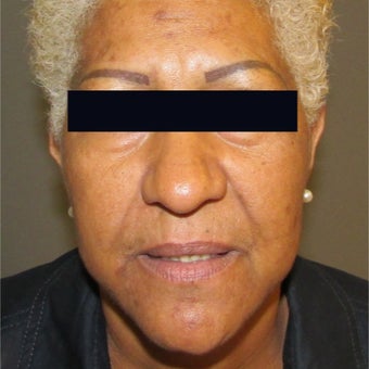 45-54 year old woman treated with Lip Augmentation before 1946372