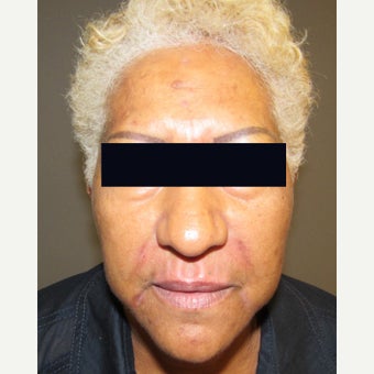45-54 year old woman treated with Lip Augmentation after 1946372