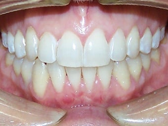 Very crowded upper and lower teeth treated with Invisalign after 930236