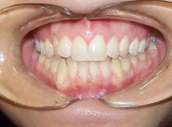 Very crowded upper and lower teeth treated with Invisalign before 930236