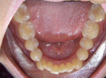 Very crowded upper and lower teeth treated with Invisalign 930236