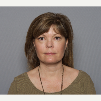 45-54 year old woman treated with Facelift after 3605965