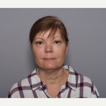 45-54 year old woman treated with Facelift before 3605965