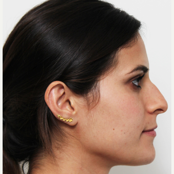 18-24 year old woman treated with Rhinoplasty before 3371969