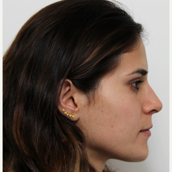 18-24 year old woman treated with Rhinoplasty after 3371969