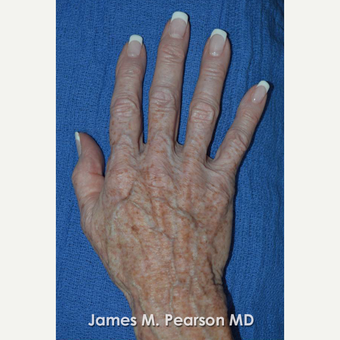 65-74 year old woman treated with Radiesse before 3814914