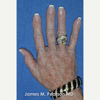 65-74 year old woman treated with Radiesse after 3814914