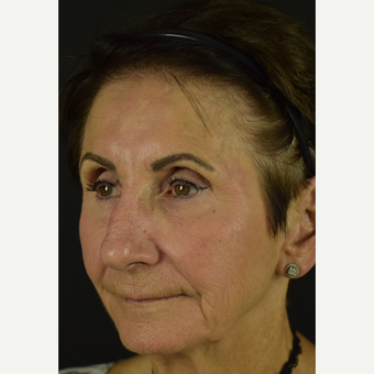 Cheek Lifting, Corner of Mouth Tightening, and Jowl Softening with the NovaLift before 3793571
