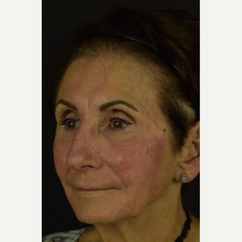 Cheek Lifting, Corner of Mouth Tightening, and Jowl Softening with the NovaLift after 3793571