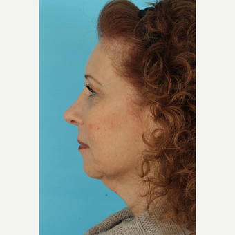 55-64 year old woman treated with Facelift before 3691401