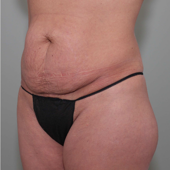 35-44 year old woman treated with Tummy Tuck before 3069728