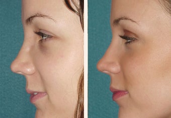 24 y.o female who broke her nose in an automobile accident after 666464
