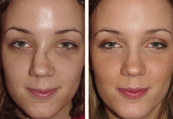 24 y.o female who broke her nose in an automobile accident before 666464