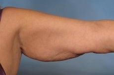 Arm Lift 923719