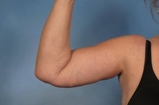 Arm Lift after 923719