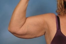Arm Lift before 923719