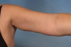 Arm Lift 923719