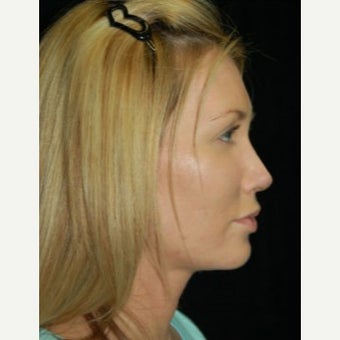 Fat Transfer after 1637886
