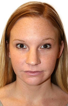 Rhinoplasty before 359769