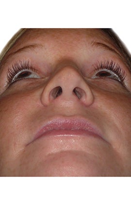 Rhinoplasty 359769