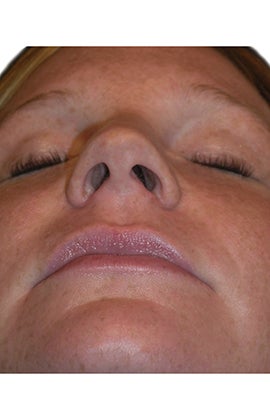 Rhinoplasty 359769