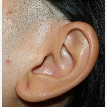 18-24 year old man treated with Laser Hair Removal before 2910006