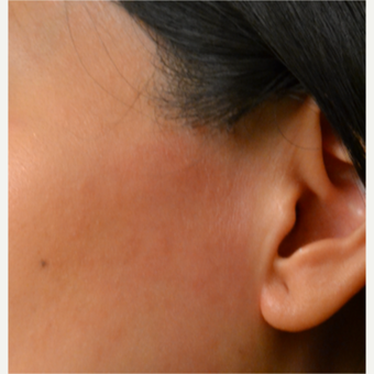 18-24 year old man treated with Laser Hair Removal after 2910006