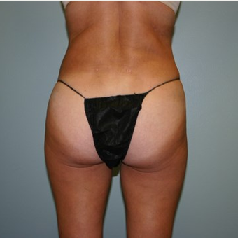 55-64 year old woman treated with Brazilian Butt Lift after 3667546