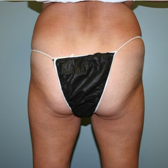55-64 year old woman treated with Brazilian Butt Lift before 3667546