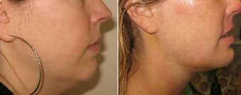 Neck Liposuction and Chin Implant before 69344